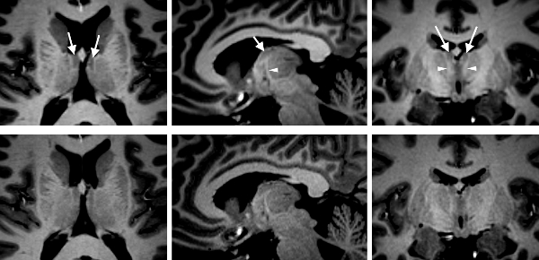 abb4_thalamus_anteroventral abb4_thalamus_anteroventral