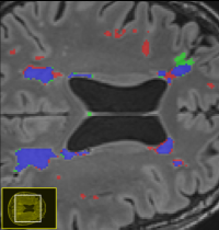 BA WMH Segmentation